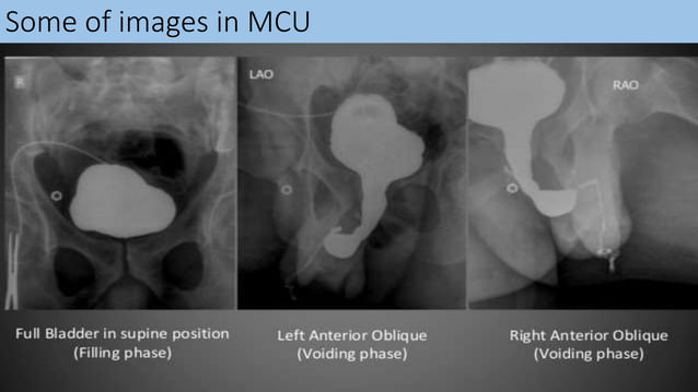Radiological procedure of retrograde urethrography(rgu) and micturating ...