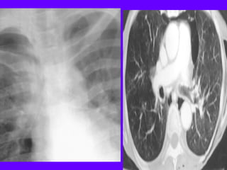 Radiological signs in chest medicine | PDF