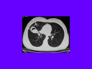 Radiological signs in chest medicine | PDF