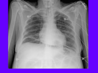 Radiological signs in chest medicine | PDF