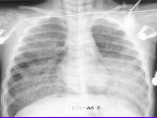 Radiological Signs in Chest Medicine | PDF