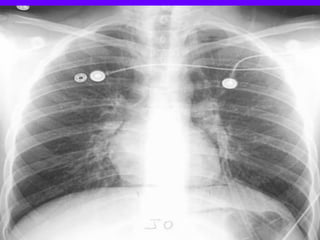 Martel Sign Radiograph Radiological Signs in Chest Medicine | PDF