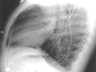 Radiological Signs in Chest Medicine | PDF