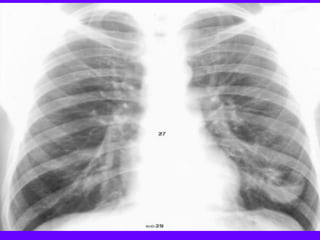 Radiological Signs in Chest Medicine | PDF
