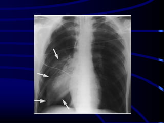 Triangular Sign Chest Radiological signs in chest medicine Part 1 | PDF