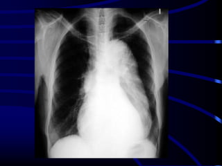 Radiological signs in chest medicine Part 1 | PDF