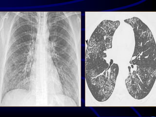 Radiological signs in chest medicine Part 1 | PDF