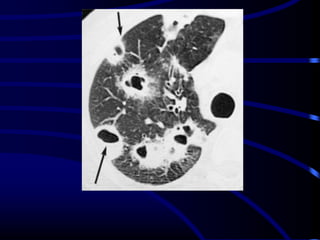Radiological signs in chest medicine Part 1 | PDF