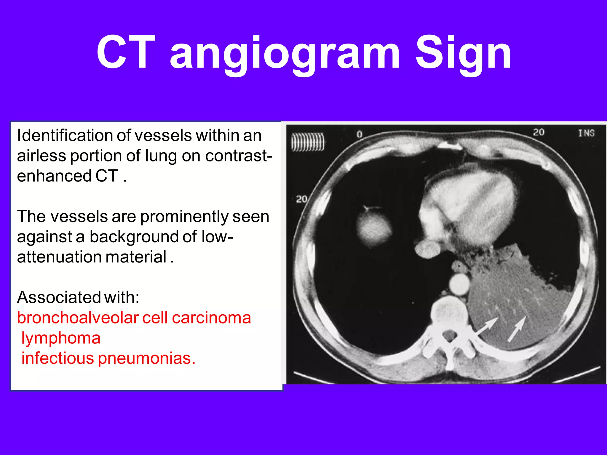 Radiological signs in chest medicine part 2 | PDF