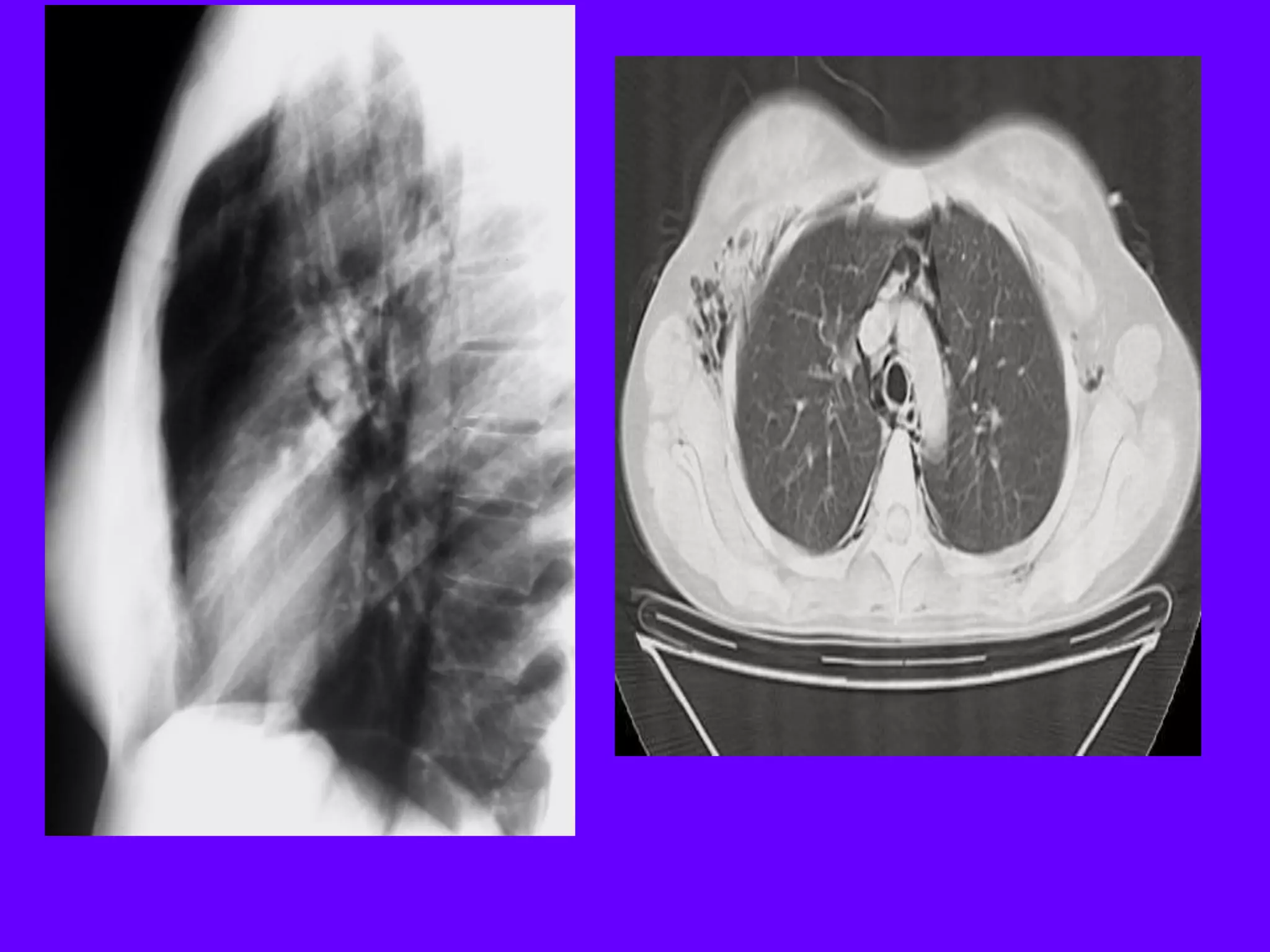 Radiological signs in chest medicine part 2 | PDF