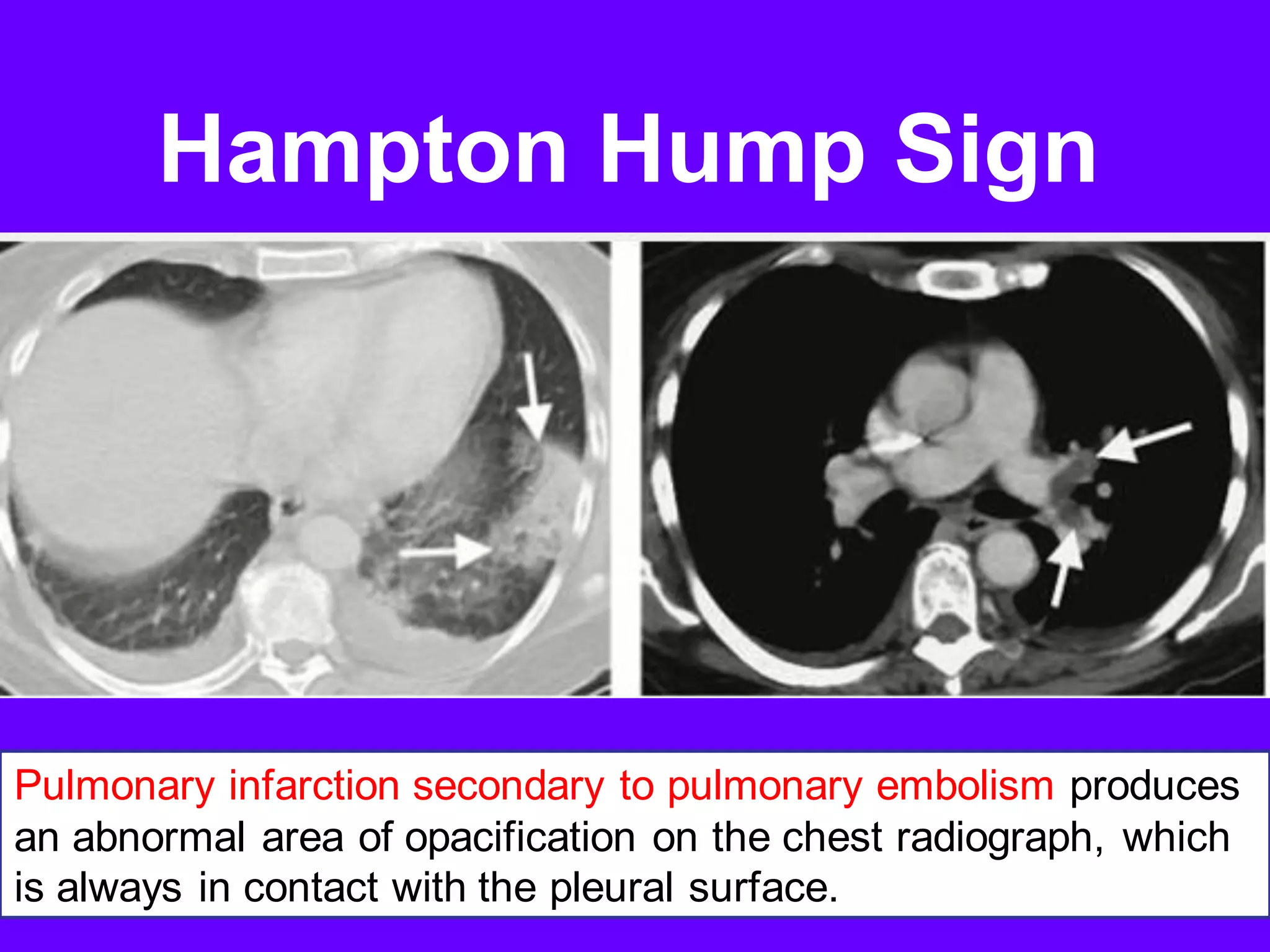 Radiological signs in chest medicine part 2 | PDF