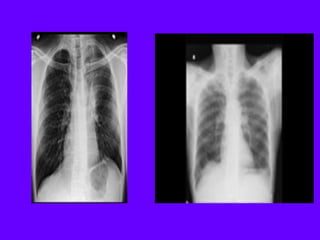 Radiological signs in chest medicine part 2 | PDF