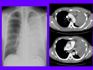 Radiological signs in chest medicine part 2 | PDF
