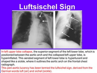 Luftcycle Sign Radiological signs in chest medicine part 2 | PDF