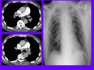 Radiological signs in chest medicine part 2 | PDF