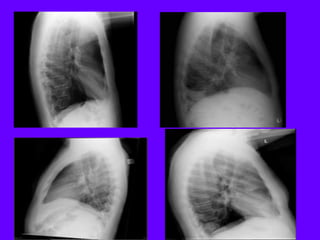 Radiological signs in chest medicine part 2 | PDF