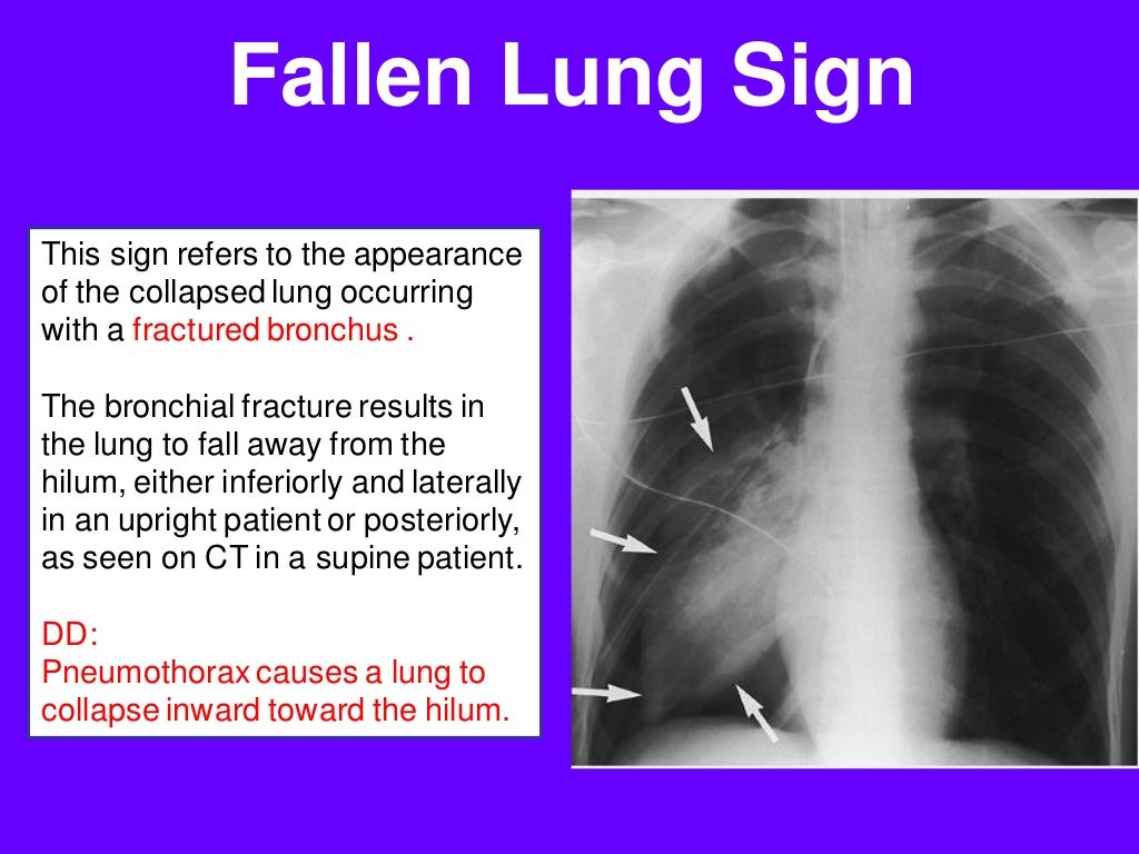 Radiological signs in chest medicine part 2