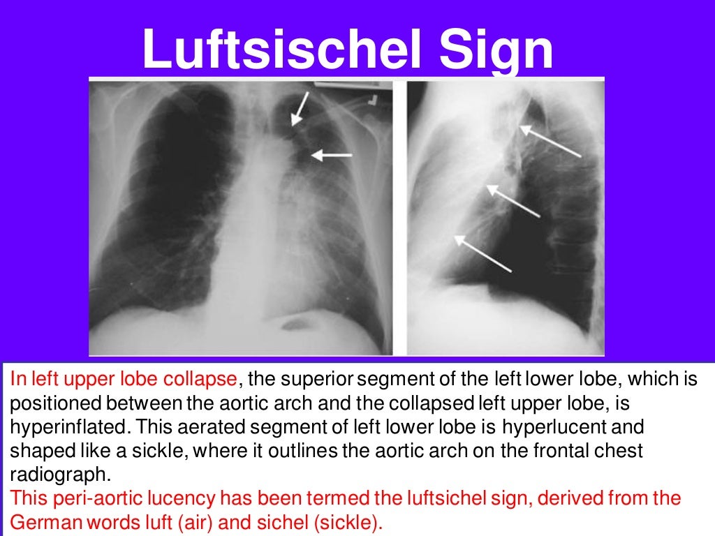 Radiological signs in chest medicine part 2