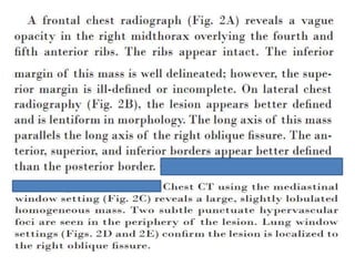 Radiological signs in thoracic imaging ( AJR article) | PPTX