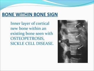 BONE WITHIN BONE SIGN
Inner layer of cortical
new bone within an
existing bone seen with
OSTEOPETROSIS,
SICKLE CELL DISEAS...
