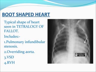 BOOT SHAPED HEART
Typical shape of heart
seen in TETRALOGY OF
FALLOT.
Includes:-
1.Pulmonary infundibular
stenosis.
2.Over...