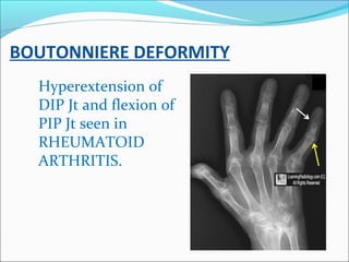 BOUTONNIERE DEFORMITY
Hyperextension of
DIP Jt and flexion of
PIP Jt seen in
RHEUMATOID
ARTHRITIS.
 