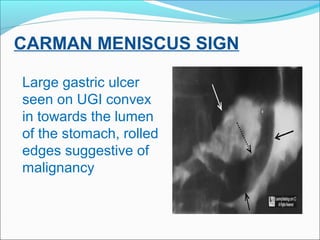 CARMAN MENISCUS SIGN
Large gastric ulcer
seen on UGI convex
in towards the lumen
of the stomach, rolled
edges suggestive o...