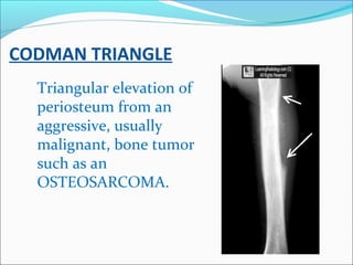 CODMAN TRIANGLE
Triangular elevation of
periosteum from an
aggressive, usually
malignant, bone tumor
such as an
OSTEOSARCO...