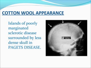COTTON WOOL APPEARANCE
Islands of poorly
marginated
sclerotic disease
surrounded by less
dense skull in
PAGETS DISEASE.
 
