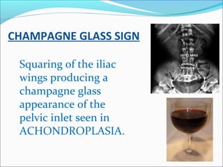 CHAMPAGNE GLASS SIGN
Squaring of the iliac
wings producing a
champagne glass
appearance of the
pelvic inlet seen in
ACHOND...