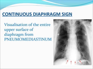 CONTINUOUS DIAPHRAGM SIGN
Visualisation of the entire
upper surface of
diaphragm from
PNEUMOMEDIASTINUM
 