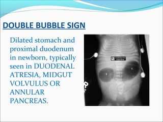 DOUBLE BUBBLE SIGN
Dilated stomach and
proximal duodenum
in newborn, typically
seen in DUODENAL
ATRESIA, MIDGUT
VOLVULUS O...
