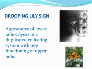 DROOPING LILY SIGN
Appearance of lower
pole calyces in a
duplicated collecting
system with non
functioning of upper
pole.
 