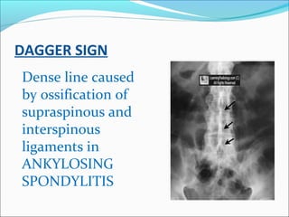 DAGGER SIGN
Dense line caused
by ossification of
supraspinous and
interspinous
ligaments in
ANKYLOSING
SPONDYLITIS
 