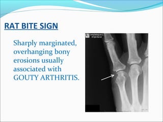 RAT BITE SIGN
Sharply marginated,
overhanging bony
erosions usually
associated with
GOUTY ARTHRITIS.
 