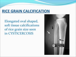 RICE GRAIN CALCIFICATION
Elongated oval shaped,
soft tissue calcifications
of rice grain size seen
in CYSTICERCOSIS
 