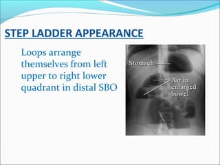 STEP LADDER APPEARANCE
Loops arrange
themselves from left
upper to right lower
quadrant in distal SBO
 