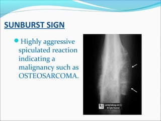 SUNBURST SIGN
Highly aggressive
spiculated reaction
indicating a
malignancy such as
OSTEOSARCOMA.
 