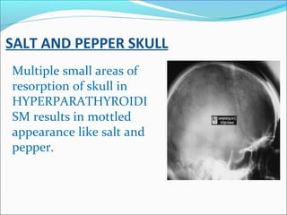 SALT AND PEPPER SKULL
Multiple small areas of
resorption of skull in
HYPERPARATHYROIDI
SM results in mottled
appearance li...