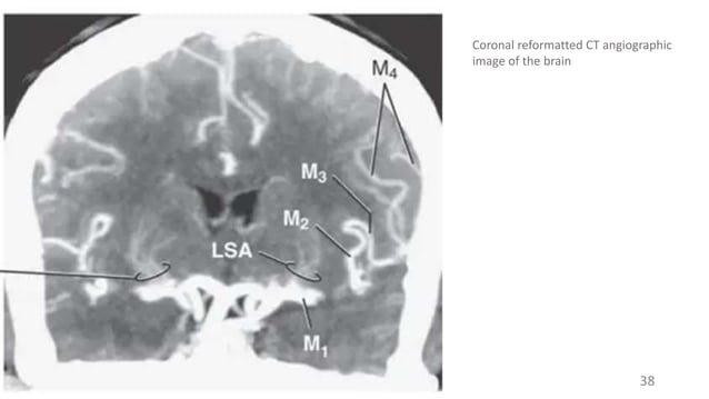 Radiologic Anatomy of the Blood Supply to the Brain.pptx