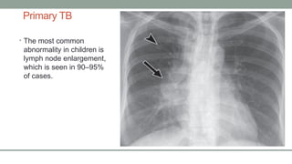 Radiologic features of pulmonary tuberculosis.pptx