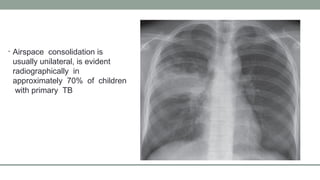Pbc Radiographically Radiologic features of pulmonary tuberculosis.pptx