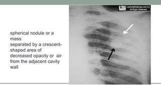 Radiologic features of pulmonary tuberculosis.pptx