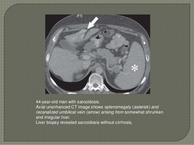 Radiologic mimics of cirrhosis Radiologic mimics of cirrhosis