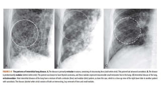 RADIOLOGIC PULMONARY ANATOMY STUDIES.PPT