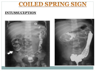 Radiology signs and symptoms | PDF