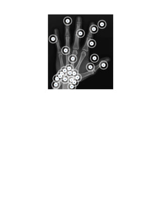 First Ray Hand Radiology Anatomy of the Hand and Wrist | PDF
