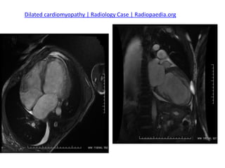 RADIOLOGY AND IMAGING for dilated cardiomyopatht | PDF