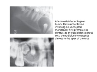 Aot Radiograph RADIOLOGY AND IMAGING OF ORAL PATHOLOGIES.pptx