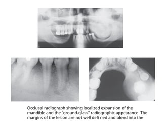 Glass Radiograph RADIOLOGY AND IMAGING OF ORAL PATHOLOGIES.pptx
